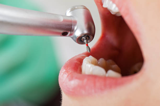 Best Dental Abscess Treatment in Fairfax, IA